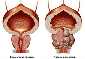 Аденома простаты: симптомы, диагностика и лечение у мужчин